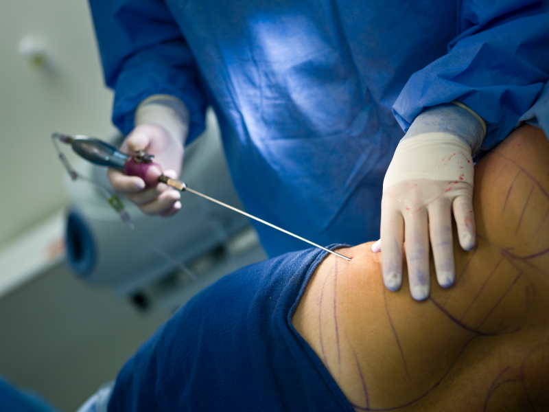 Subir une liposuccion et une lipoaspiration