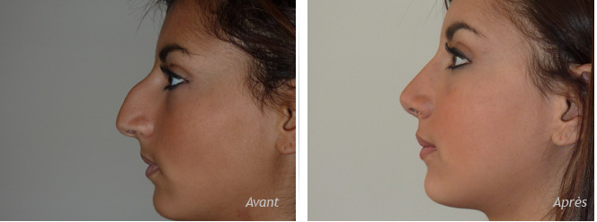 Quelle technique pour se refaire un beau nez
