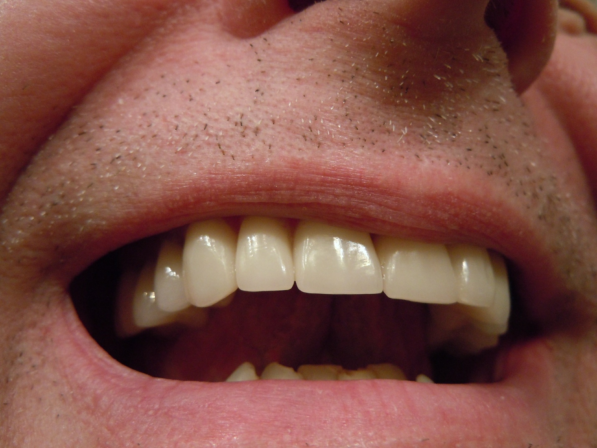 Tout savoir sur les implants dentaires